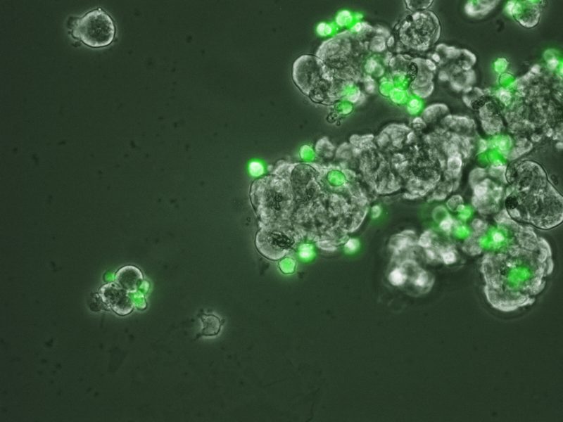 Cancer spheroids attacked by macrophages