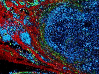  A breast tumor (blue) grows within the surrounding mammary tissue (red), while lymphatic vessels (green) form a network around it.